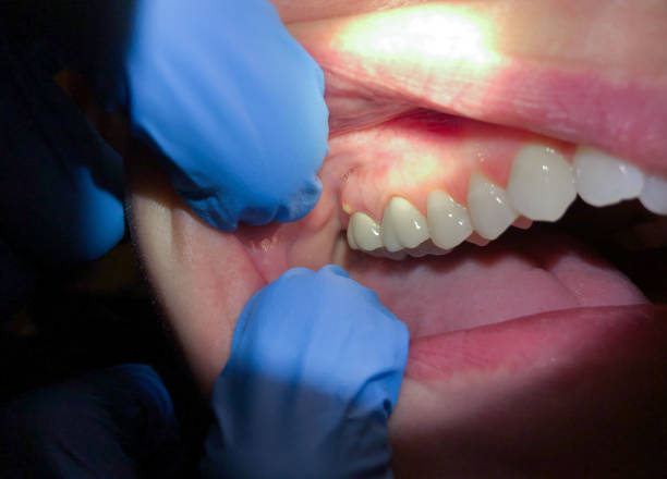 Best Emergency Dentist for Knocked-Out Tooth in Marlton, MD